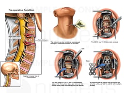 Cervical Spine Injury with Surgical Repairs