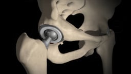 Minimally Invasive Direct Anterior Total Hip Replacement (THR)