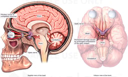 Pituitary Tumor Causing Permanent Optic Nerve Damage