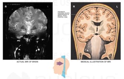 Cerebral Hemorrhages