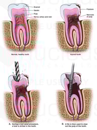 Internal Tooth Injuries with Multiple Root Canal Procedures