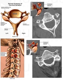 Fracture of the Third Cervical Vertebra