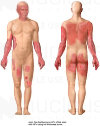 Front and Back Male Figures with Post-accident Burn Injuries