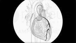 How are Angiograms Used to Find Coronary Artery Blockages?