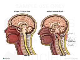 Cervical Spine Injuries