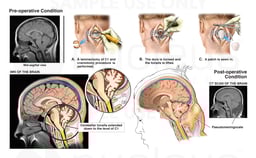 Chiari I Malformation with Surgical Decompression and Resulting Pseudomeningocele