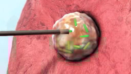 Treatment Options for Lung Cancer