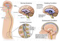 Lumbar Puncture with Subsequent Brain Damage