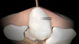Types of Acne: Cyst