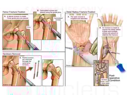 Surgical Procedures of the Left Hip and Wrist
