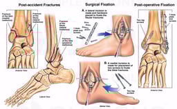 Left Tri-malleolar Ankle Fractures with Surgical Placement of Plates and Screws