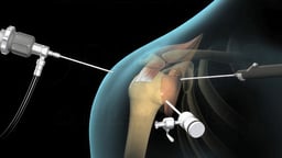 Arthroscopic Rotator Cuff Repair