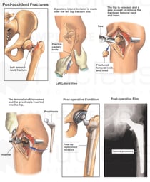 Hip Fracture with Subsequent Joint Replacement Surgery