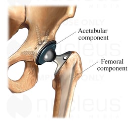 THR: Hip Prosthesis
