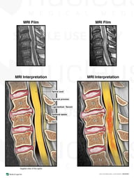 Cervical Injection with Resulting Spinal Cord Injury