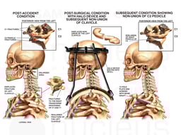 Cervical Spine Injury with Placement of Halo Vest
