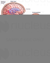 Traumatic Brain Injuries