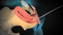 Dilation and Curettage (D and C)