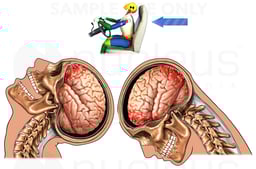 Whiplash - Coup and Contrecoup Closed Head Injury
