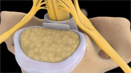 Deterioration of Intervertebral Discs