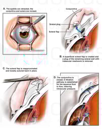 Worsening Glaucoma Treated with Trabeculectomy Eye Surgery