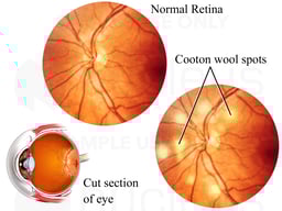 Hypertensive Retinopathy