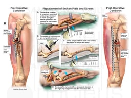 Open Reduction and Internal Fixation of Right Femoral Shaft