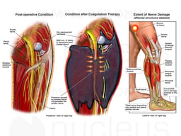 Post-operative Hemorrhage Following Anti-coagulation Therapy with Nerve Damage
