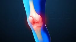 Osteoarthritis