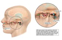 Post-operative CSF Leak