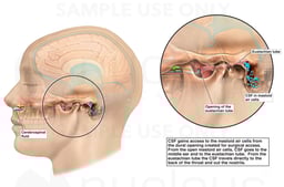 Post-operative CSF Leak