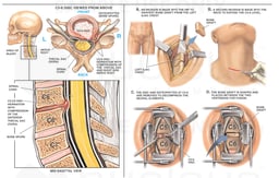 C5-6 Anterior Cervical Discectomy and Fusion