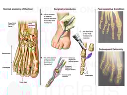 Surgical Revision of the Right Third Metatarsal