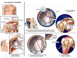 Right Shoulder Injuries with Surgical Procedures