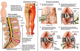 Lumbar Spine Injury with Surgical Laminectomy and Discectomy