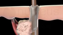 Follicular Canal Filled with Sebum