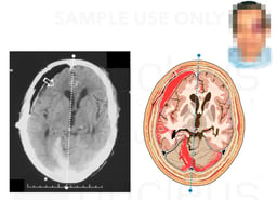 Fatal Intracranial hemorrhage