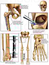 Post-operative Condition of Facial, Hip, Leg and Ankle Surgeries