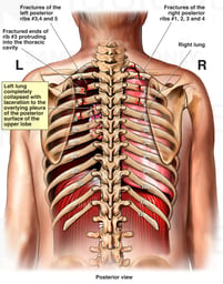 Rib Fractures