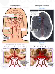 Progression of Cerebral Aneurysm