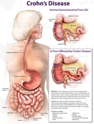 Crohn's Disease