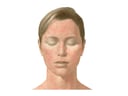 Measles (Rubeola) Rash