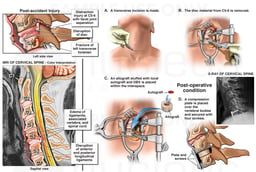 Cervical Spine injury with Anterior Discectomy and Fusion