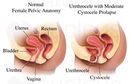 Urethrocele