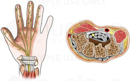 Carpal Tunnel