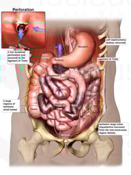 Duodenal Perforation and Resulting Ischemic Small Bowel