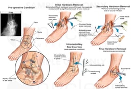 Left Foot and Ankle with Multiple Surgical Hardware Removal Procedures