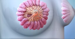 What Happens During a Lumpectomy? 