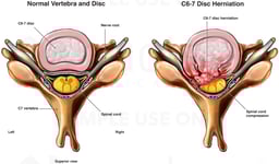 C6-7 Disc Herniation with Spinal Cord Compression