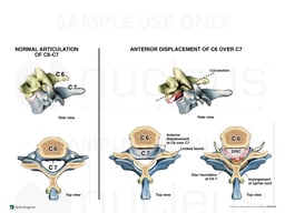 Failure to Diagnose Cervical Spine Injury in CT Scan of the Cervical Spine